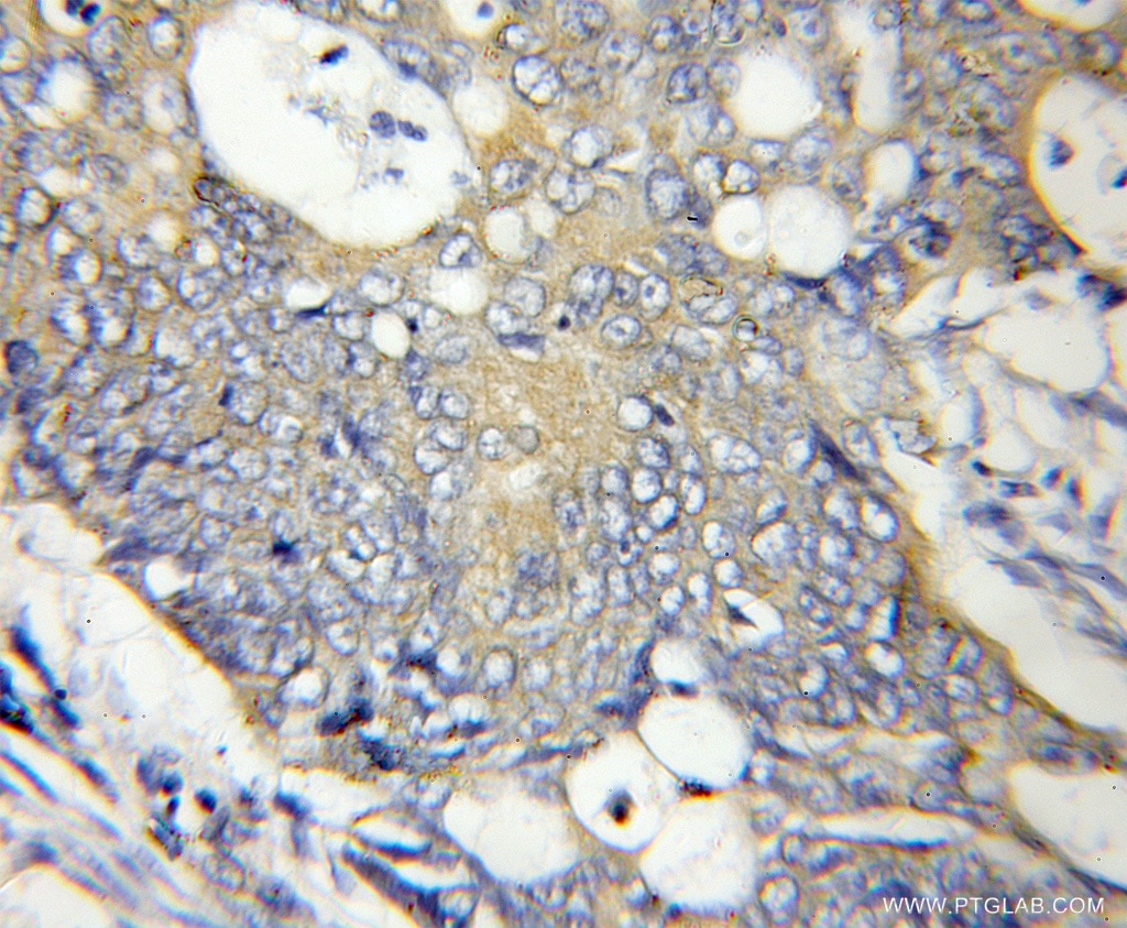 Immunohistochemistry (IHC) staining of human colon cancer tissue using ATPAF2 Polyclonal antibody (11598-1-AP)