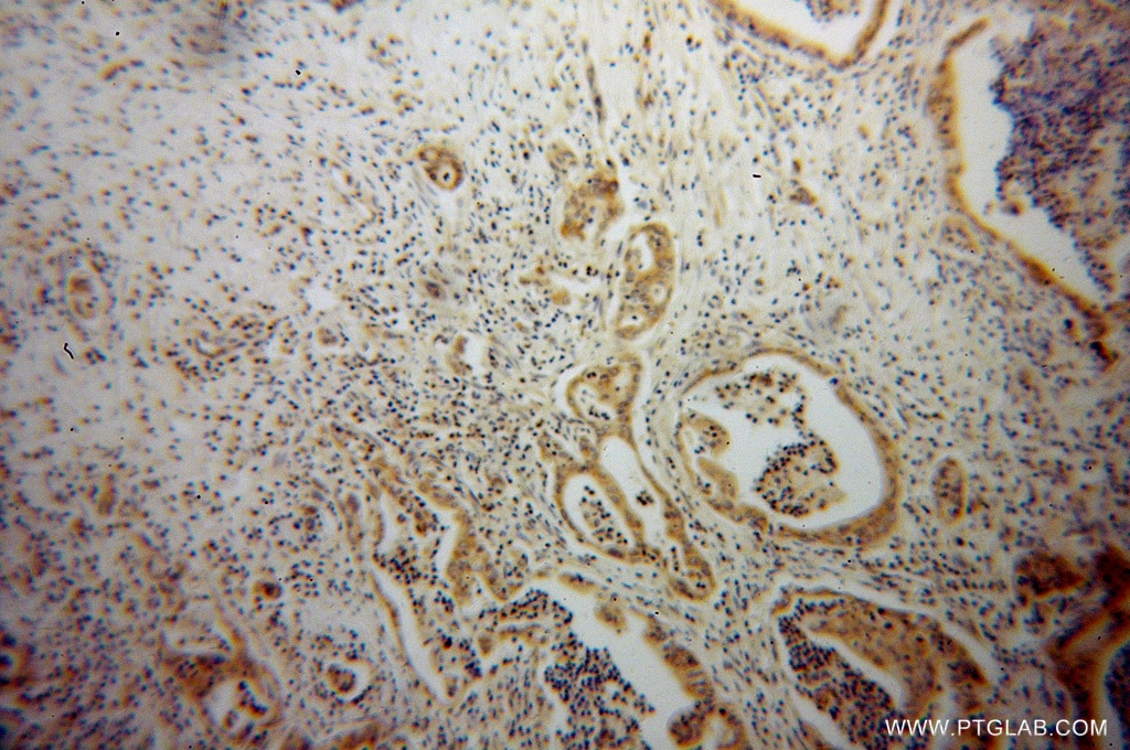 Immunohistochemistry (IHC) staining of human pancreas cancer tissue using ATX3,ATXN3 Polyclonal antibody (13505-1-AP)