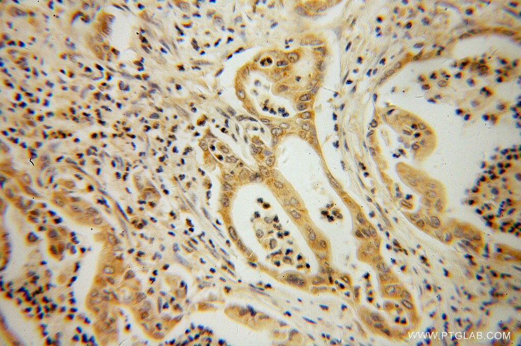 Immunohistochemistry (IHC) staining of human pancreas cancer tissue using ATX3,ATXN3 Polyclonal antibody (13505-1-AP)