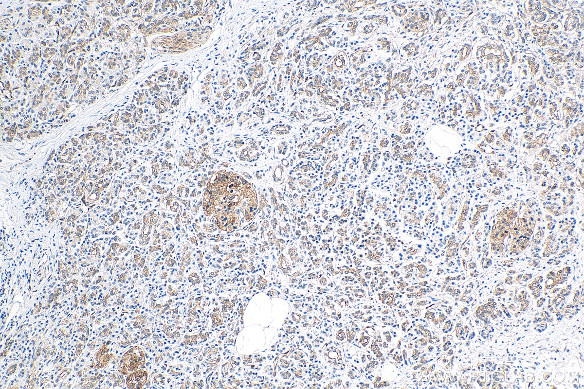 Immunohistochemistry (IHC) staining of human pancreas cancer tissue using ATX3,ATXN3 Monoclonal antibody (67057-1-Ig)