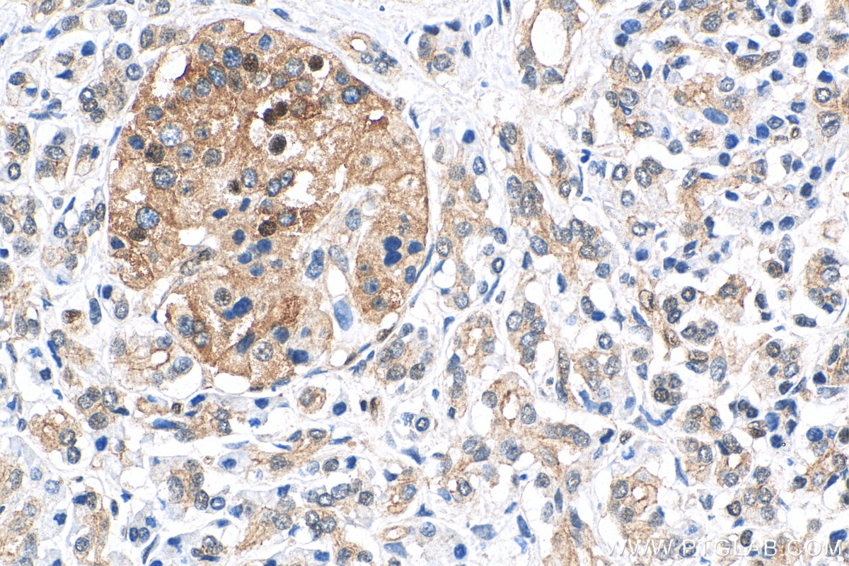 Immunohistochemistry (IHC) staining of human pancreas cancer tissue using ATX3,ATXN3 Monoclonal antibody (67057-1-Ig)