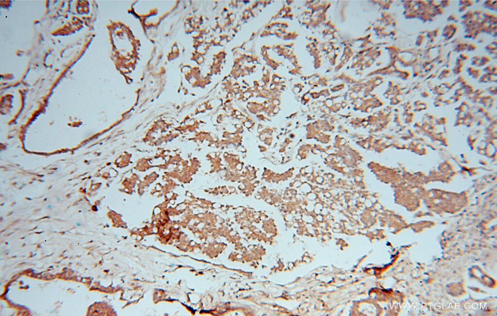 Immunohistochemistry (IHC) staining of human ovary tumor tissue using ATXN10 Polyclonal antibody (15693-1-AP)