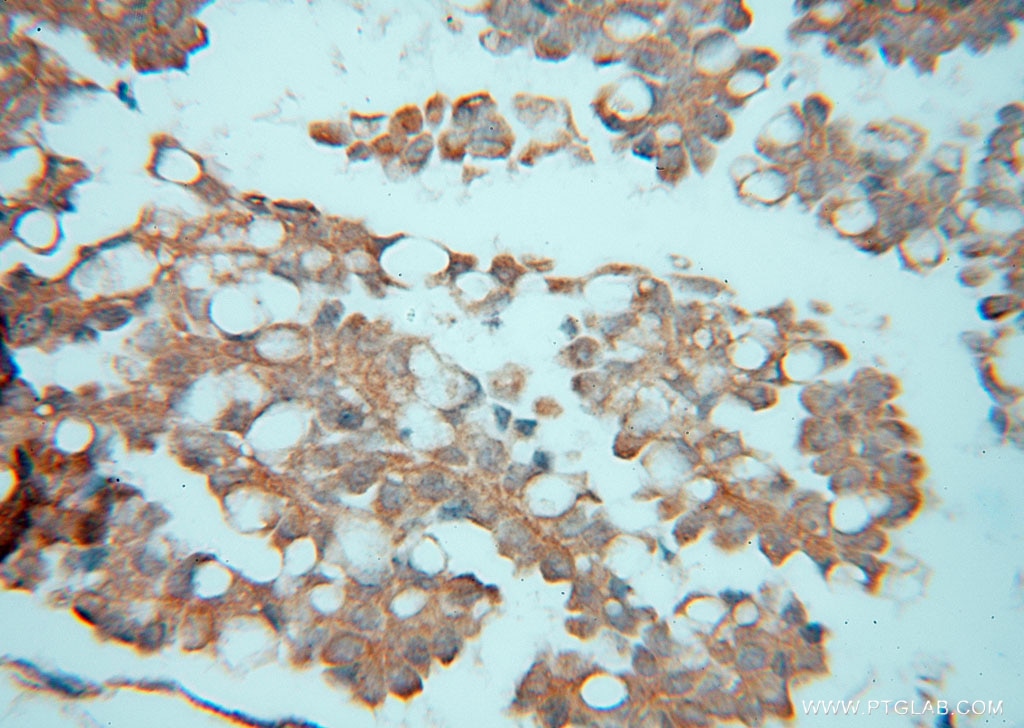 Immunohistochemistry (IHC) staining of human ovary tumor tissue using ATXN10 Polyclonal antibody (15693-1-AP)