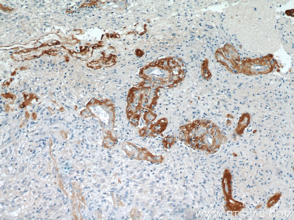 Immunohistochemistry (IHC) staining of human gliomas tissue using Ataxin 2 Polyclonal antibody (21776-1-AP)