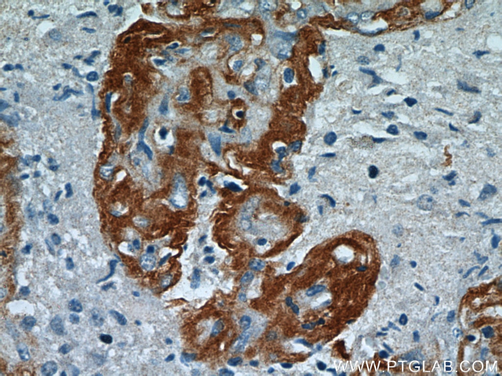Immunohistochemistry (IHC) staining of human gliomas tissue using Ataxin 2 Polyclonal antibody (21776-1-AP)