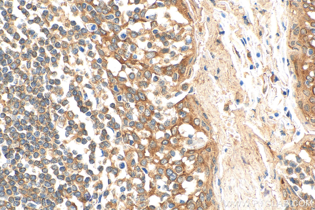 Immunohistochemistry (IHC) staining of human tonsillitis tissue using ATXN2L PolyClonal antibody (24822-1-AP)