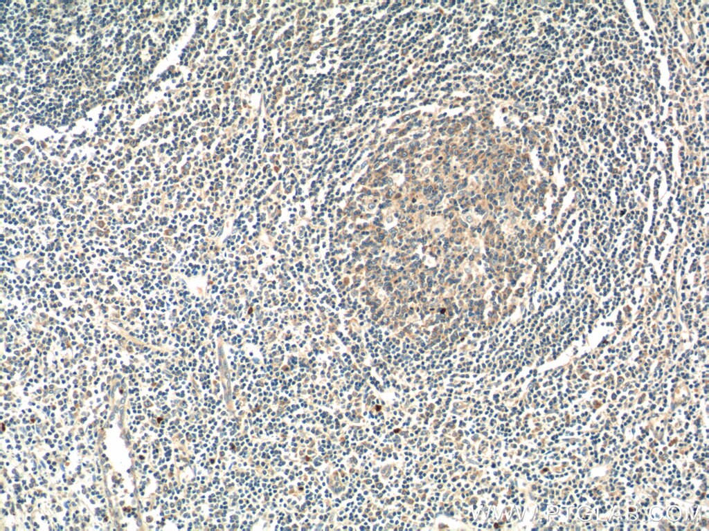 Immunohistochemistry (IHC) staining of human tonsillitis tissue using ATXN2L PolyClonal antibody (24822-1-AP)