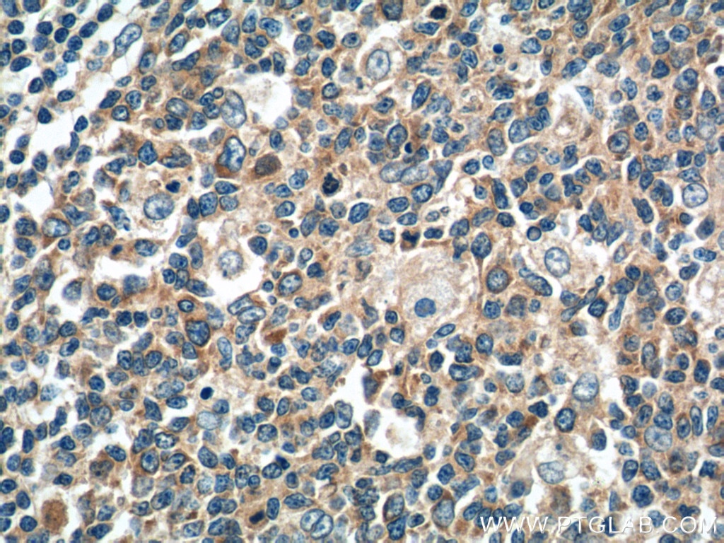 Immunohistochemistry (IHC) staining of human tonsillitis tissue using ATXN2L PolyClonal antibody (24822-1-AP)