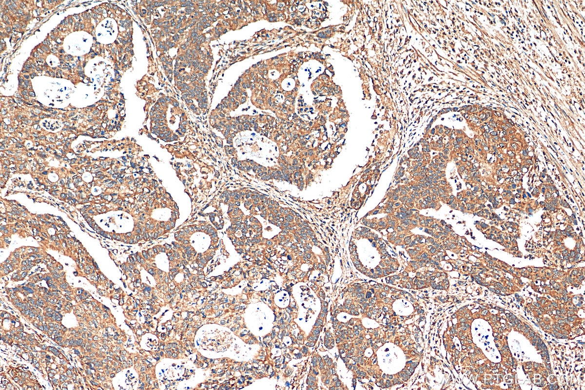 Immunohistochemistry (IHC) staining of human stomach cancer tissue using ATXN2L PolyClonal antibody (24822-1-AP)