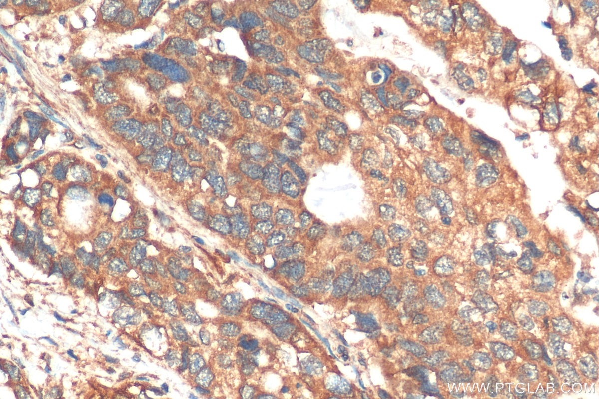 Immunohistochemistry (IHC) staining of human stomach cancer tissue using ATXN2L PolyClonal antibody (24822-1-AP)