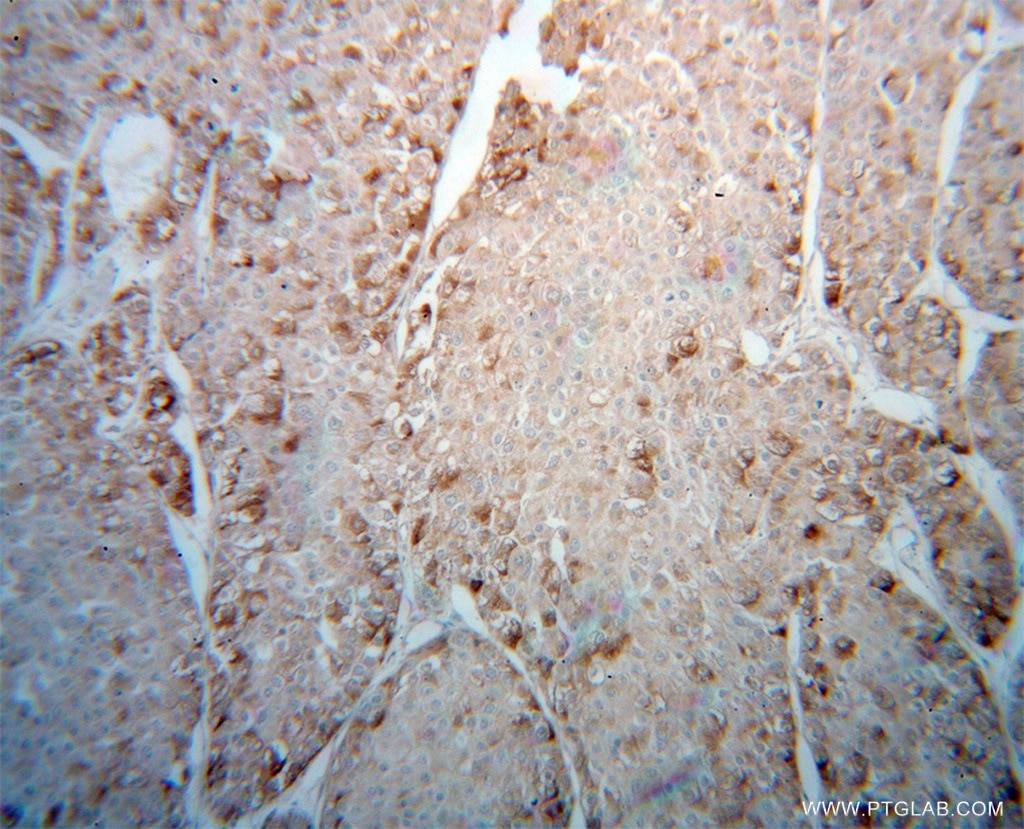 IHC staining of human liver cancer using 13726-1-AP