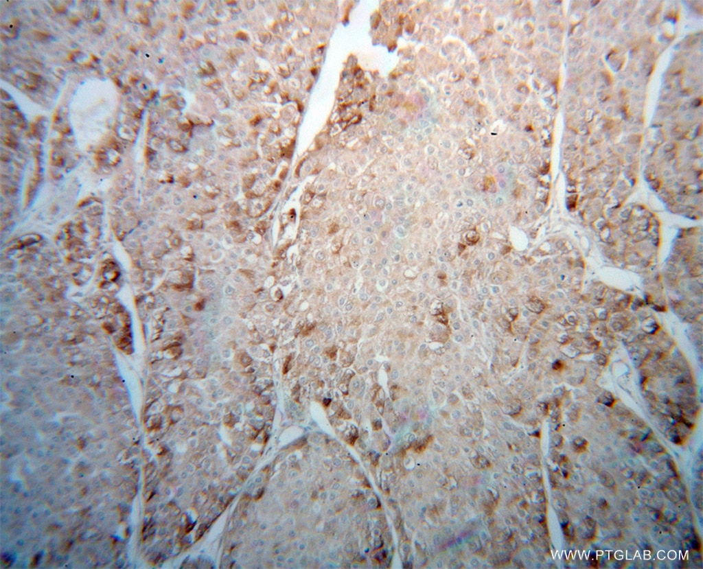 Immunohistochemistry (IHC) staining of human liver cancer tissue using AUP1 Polyclonal antibody (13726-1-AP)