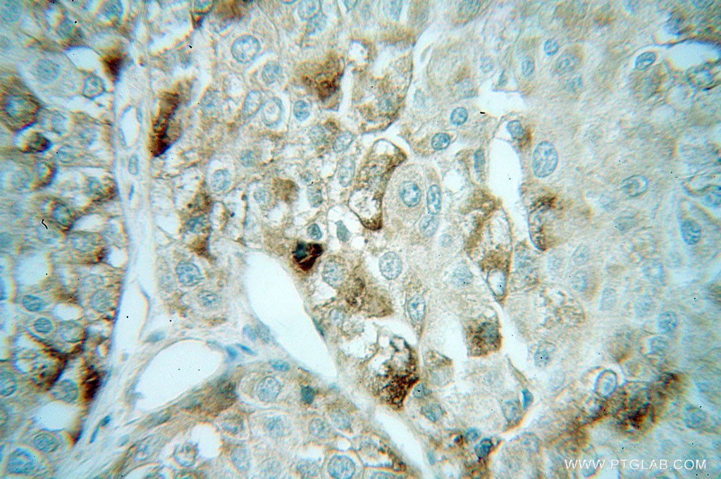 Immunohistochemistry (IHC) staining of human liver cancer tissue using AUP1 Polyclonal antibody (13726-1-AP)