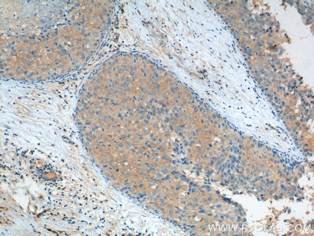 Immunohistochemistry (IHC) staining of human breast cancer tissue using Aurora A Polyclonal antibody (10297-1-AP)