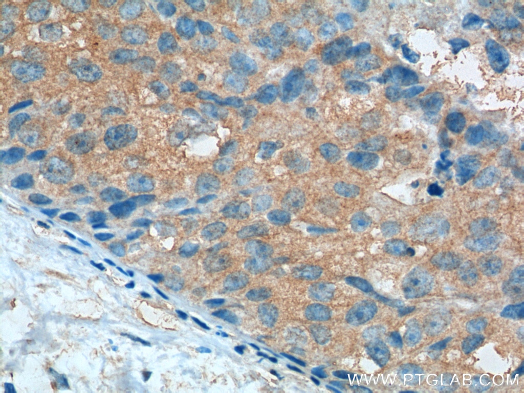 Immunohistochemistry (IHC) staining of human breast cancer tissue using Aurora A Polyclonal antibody (10297-1-AP)