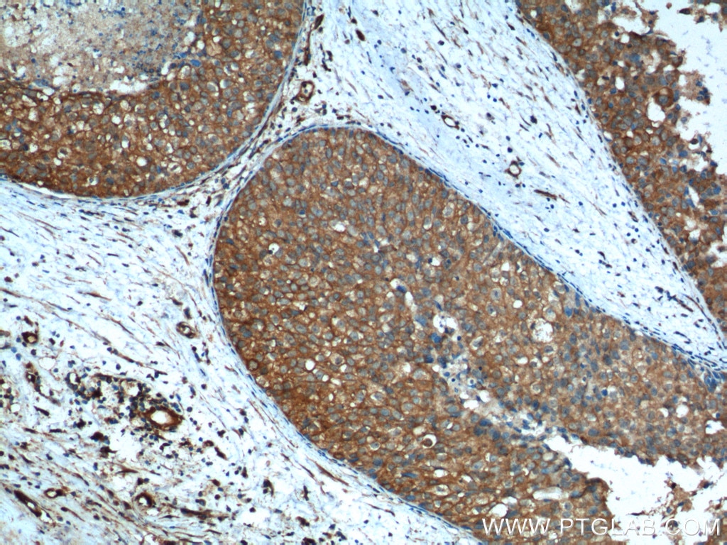 Immunohistochemistry (IHC) staining of human breast cancer tissue using Aurora A Polyclonal antibody (10297-1-AP)