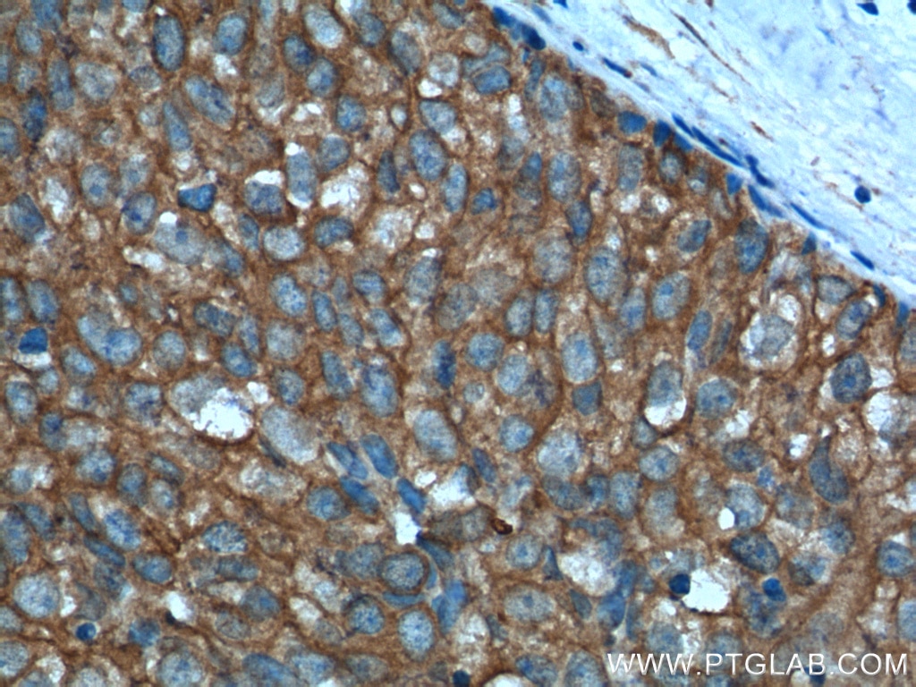 Immunohistochemistry (IHC) staining of human breast cancer tissue using Aurora A Polyclonal antibody (10297-1-AP)