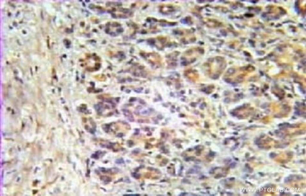 Immunohistochemistry (IHC) staining of human breast cancer tissue using Aurora A Polyclonal antibody (10297-1-AP)