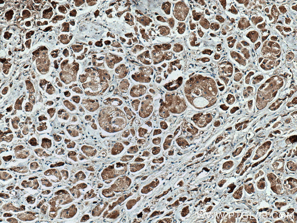 Immunohistochemistry (IHC) staining of human breast cancer tissue using AURKA Monoclonal antibody (66757-1-Ig)