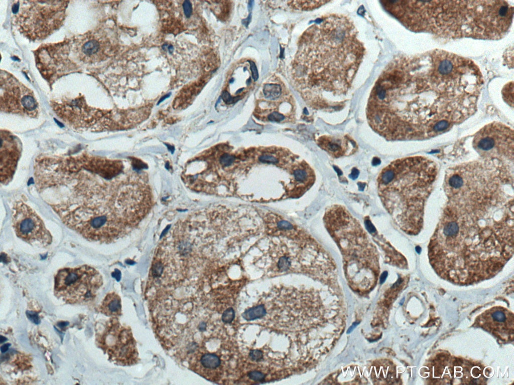 Immunohistochemistry (IHC) staining of human breast cancer tissue using AURKA Monoclonal antibody (66757-1-Ig)