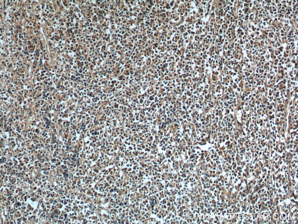 Immunohistochemistry (IHC) staining of human lymphoma tissue using Aurora B Monoclonal antibody (60098-1-Ig)