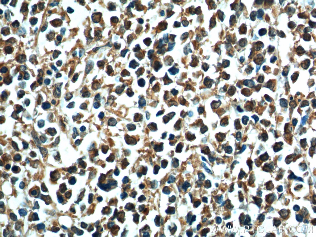 Immunohistochemistry (IHC) staining of human lymphoma tissue using Aurora B Monoclonal antibody (60098-1-Ig)