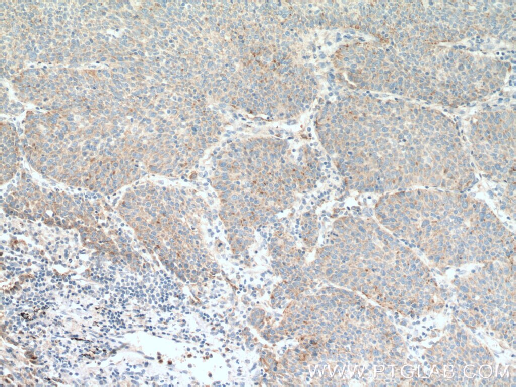 Immunohistochemistry (IHC) staining of human lung cancer tissue using AVPI1 Polyclonal antibody (12005-1-AP)