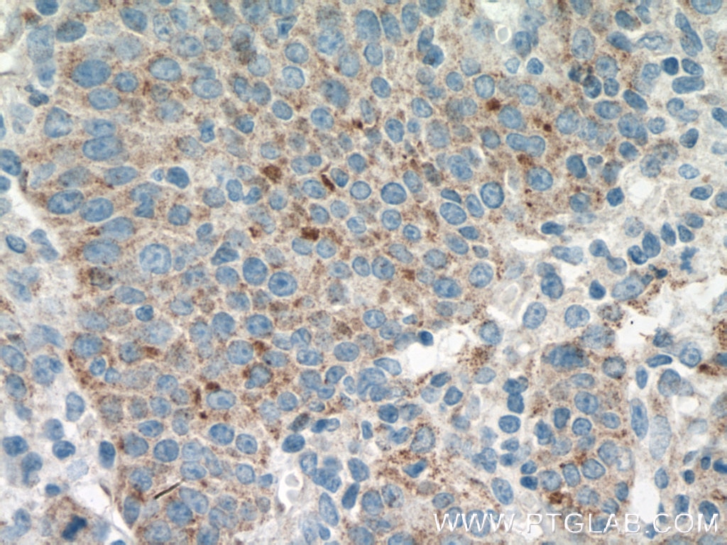 Immunohistochemistry (IHC) staining of human lung cancer tissue using AVPI1 Polyclonal antibody (12005-1-AP)