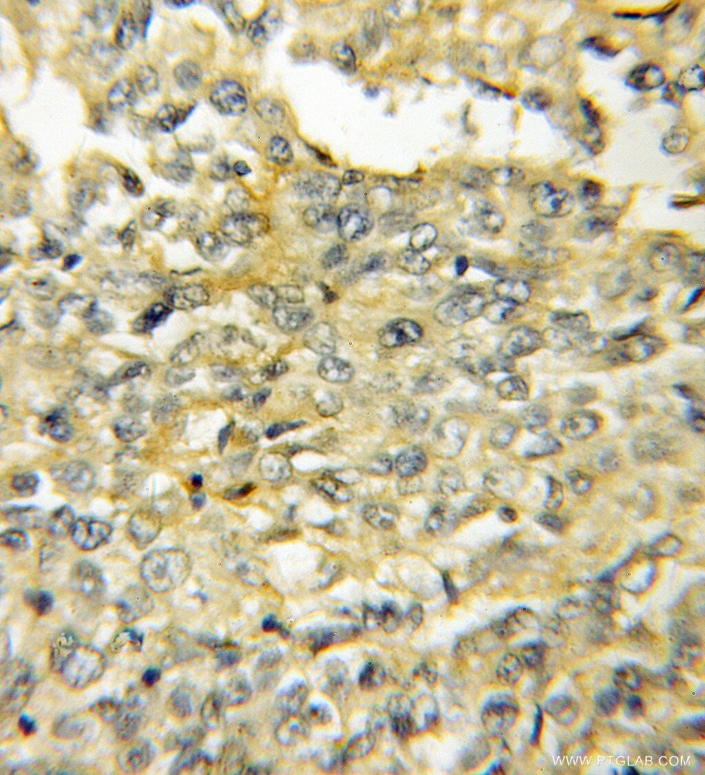 Immunohistochemistry (IHC) staining of human lung cancer tissue using AVPI1 Polyclonal antibody (12005-1-AP)