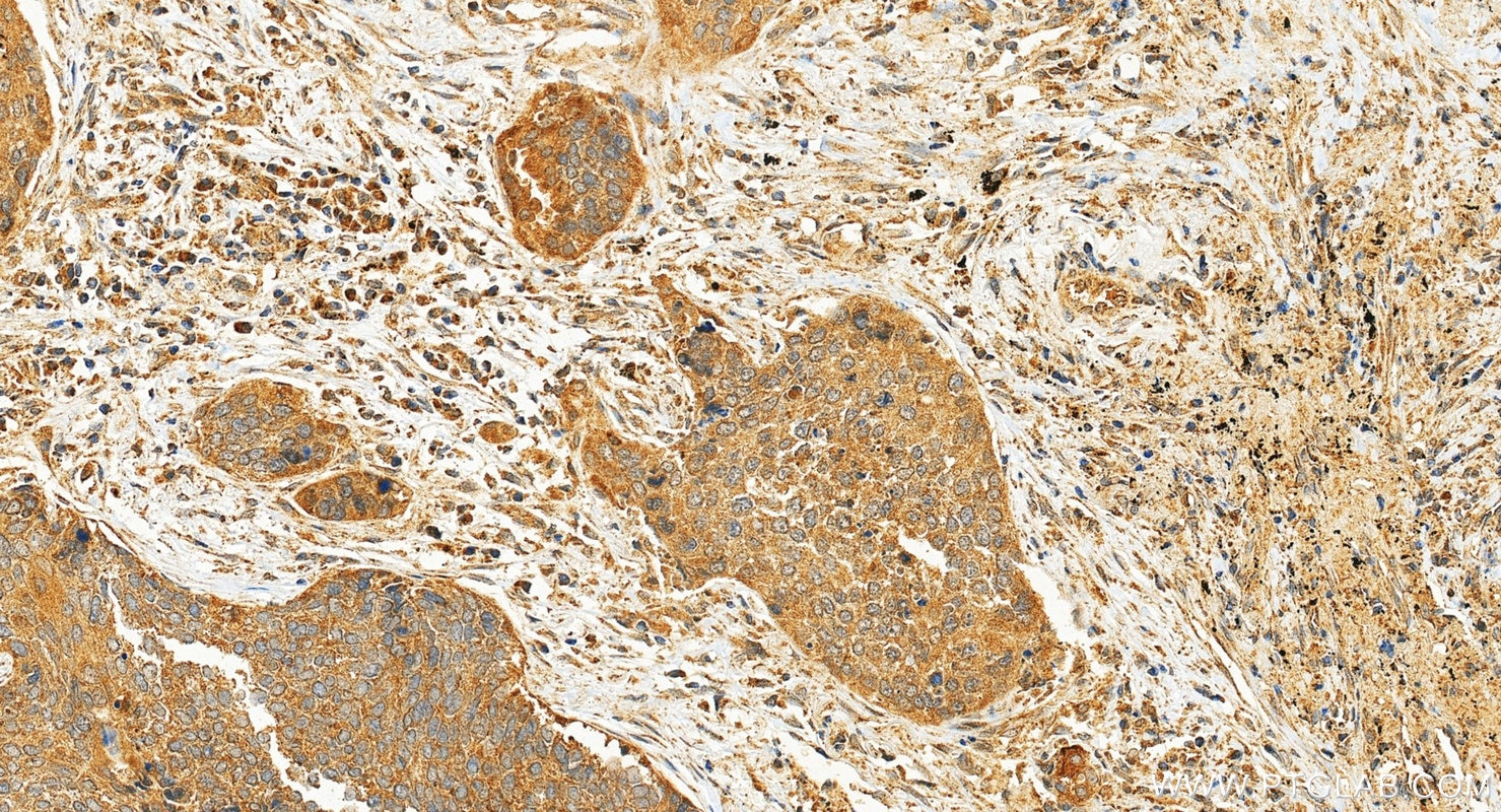 Immunohistochemistry (IHC) staining of human lung cancer tissue using AVPI1 Polyclonal antibody (12005-1-AP)