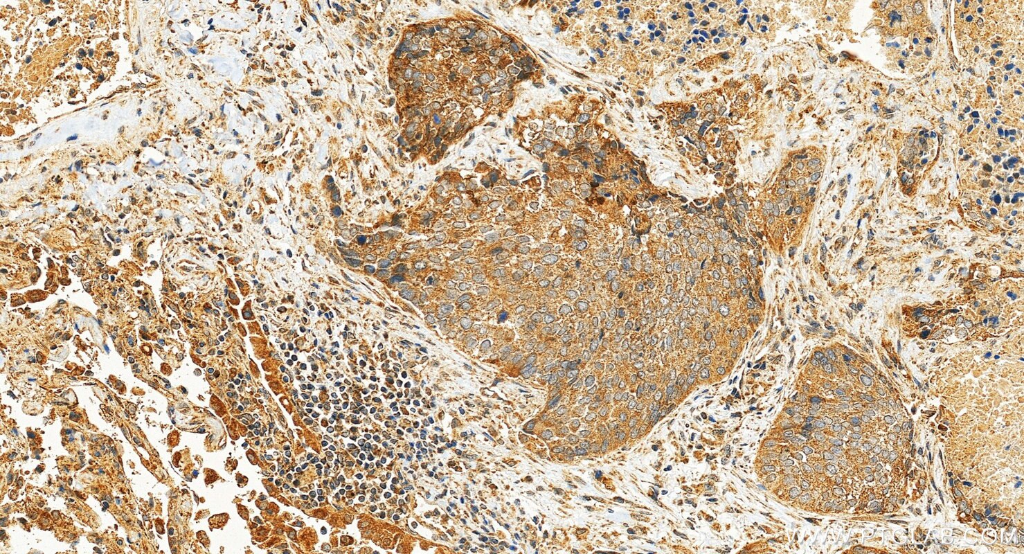Immunohistochemistry (IHC) staining of human lung cancer tissue using AVPI1 Polyclonal antibody (12005-1-AP)