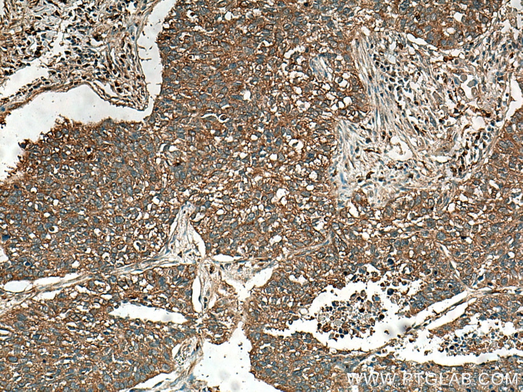 IHC staining of human lung cancer using 20540-1-AP