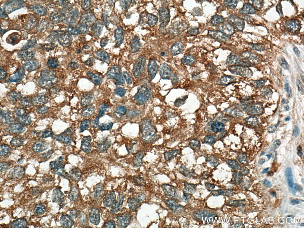 Immunohistochemistry (IHC) staining of human lung cancer tissue using AXIN2 Polyclonal antibody (20540-1-AP)