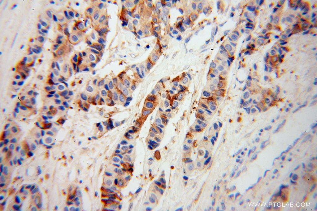 Immunohistochemistry (IHC) staining of human breast cancer tissue using Zinc Alpha 2 Glycoprotein Polyclonal antibody (13399-1-AP)