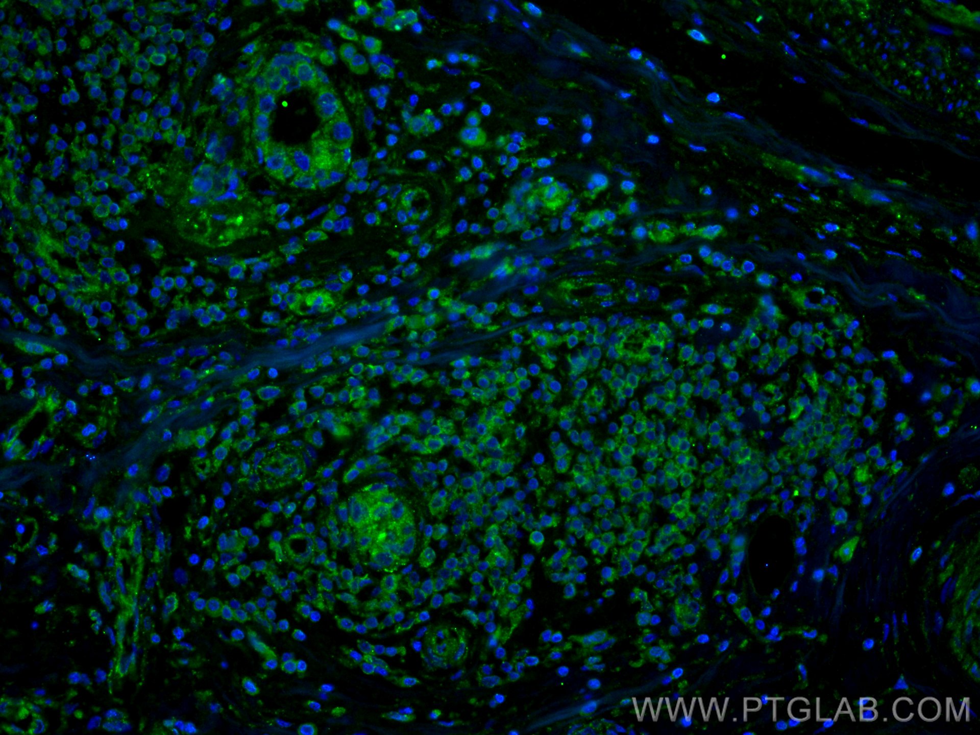 Immunofluorescence (IF) / fluorescent staining of human breast cancer tissue using Zinc Alpha 2 Glycoprotein Monoclonal antibody (66178-1-Ig)
