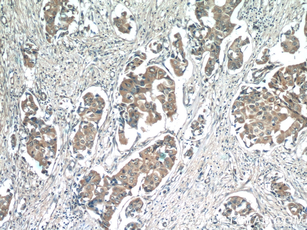 Immunohistochemistry (IHC) staining of human breast cancer tissue using Zinc Alpha 2 Glycoprotein Monoclonal antibody (66178-1-Ig)
