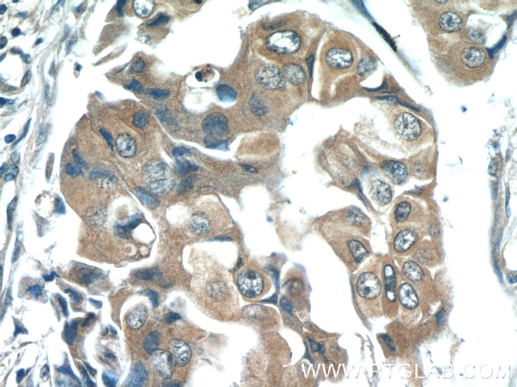 Immunohistochemistry (IHC) staining of human breast cancer tissue using Zinc Alpha 2 Glycoprotein Monoclonal antibody (66178-1-Ig)