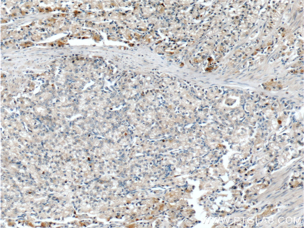 Immunohistochemistry (IHC) staining of human prostate cancer tissue using Zinc Alpha 2 Glycoprotein Monoclonal antibody (66178-1-Ig)