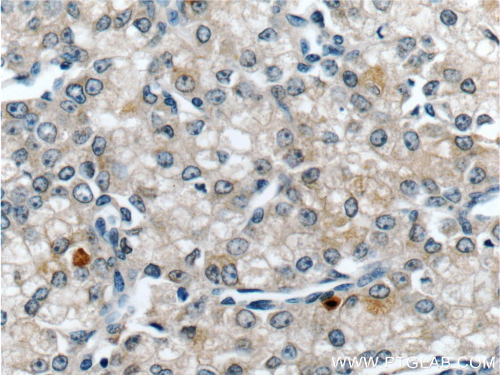 Immunohistochemistry (IHC) staining of human prostate cancer tissue using Zinc Alpha 2 Glycoprotein Monoclonal antibody (66178-1-Ig)