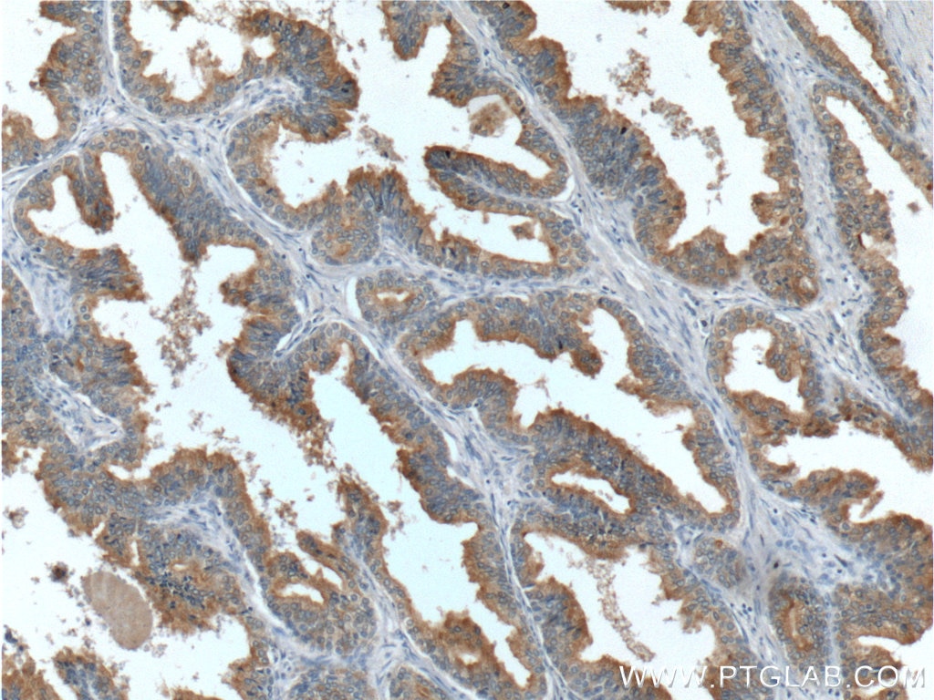 Immunohistochemistry (IHC) staining of human prostate hyperplasia tissue using Zinc Alpha 2 Glycoprotein Monoclonal antibody (66178-1-Ig)