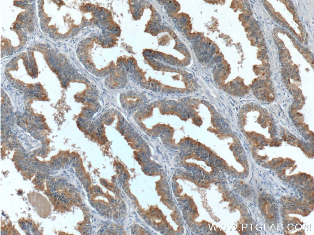 IHC staining of human prostate hyperplasia using 66178-1-Ig