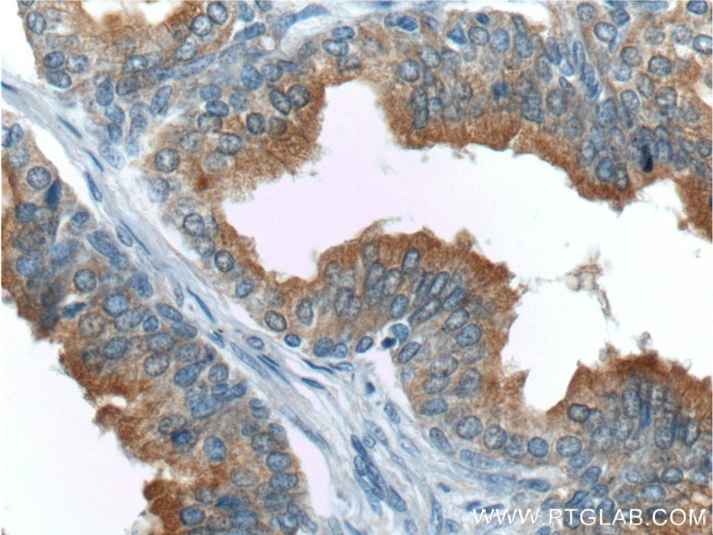 Immunohistochemistry (IHC) staining of human prostate hyperplasia tissue using Zinc Alpha 2 Glycoprotein Monoclonal antibody (66178-1-Ig)