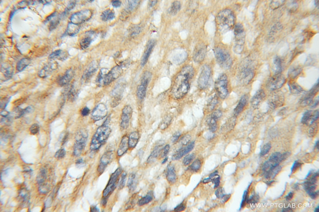 IHC staining of human gliomas using 11548-1-AP