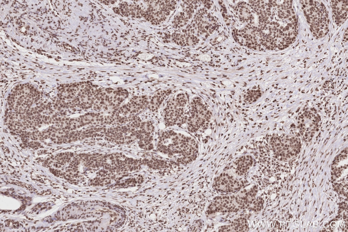 Immunohistochemistry (IHC) staining of human stomach cancer tissue using Acetyl-Histone H2A (Lys9) Recombinant monoclonal a (82823-2-RR)