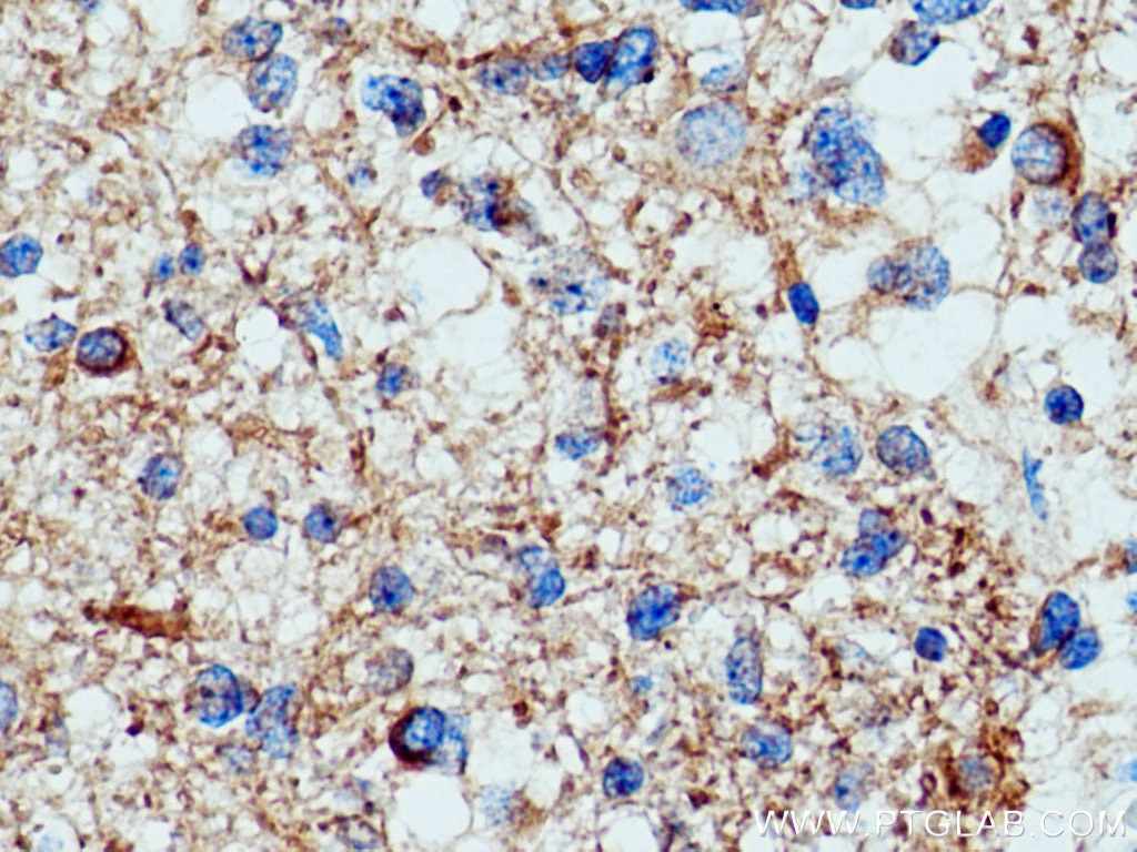 Immunohistochemistry (IHC) staining of human gliomas tissue using acetylated Tubulin(Lys40) Monoclonal antibody (66200-1-Ig)