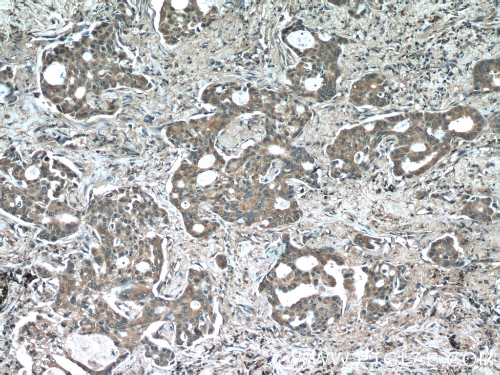 Immunohistochemistry (IHC) staining of human lung cancer tissue using acetylated Tubulin(Lys40) Monoclonal antibody (66200-1-Ig)