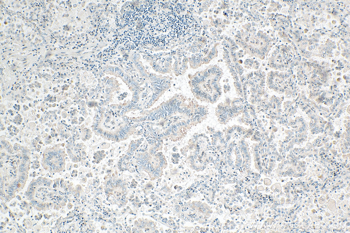 Immunohistochemistry (IHC) staining of human lung cancer tissue using Aggrecan Polyclonal antibody (30532-1-AP)