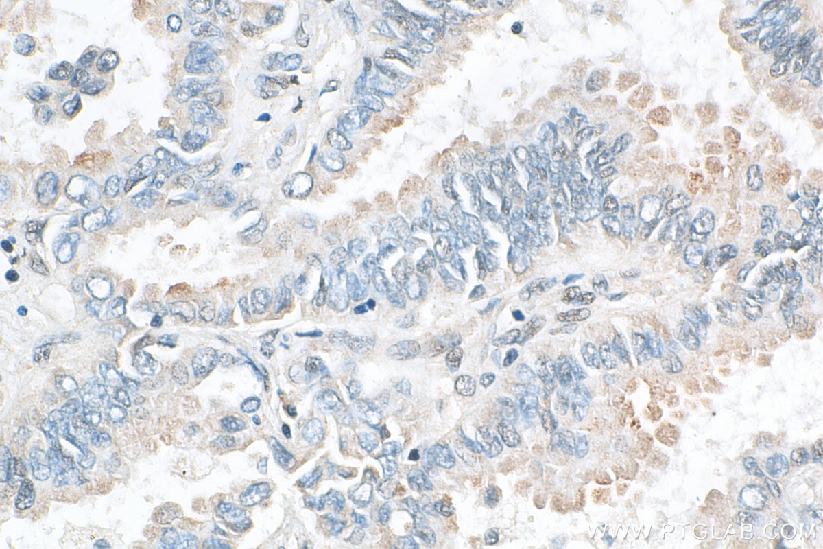 Immunohistochemistry (IHC) staining of human lung cancer tissue using Aggrecan Polyclonal antibody (30532-1-AP)