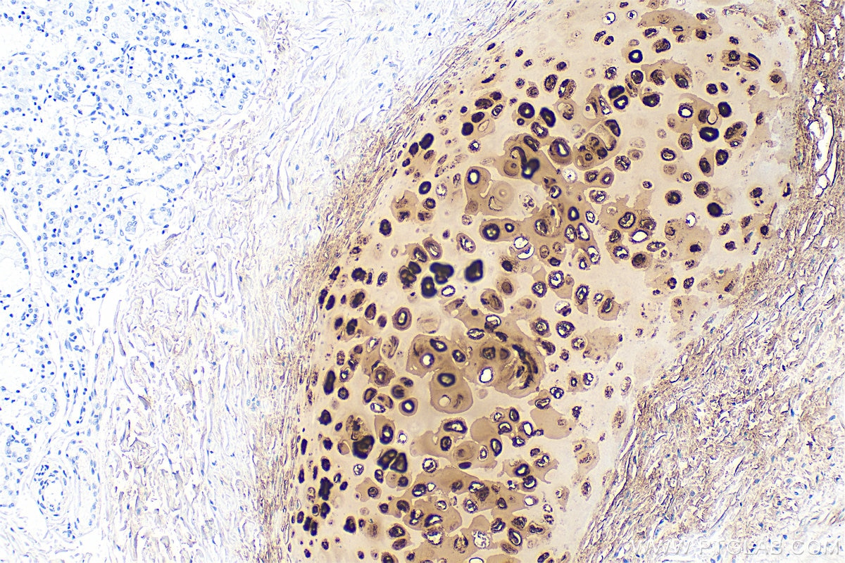Immunohistochemistry (IHC) staining of human lung cancer tissue using Aggrecan Recombinant monoclonal antibody (84819-5-RR)