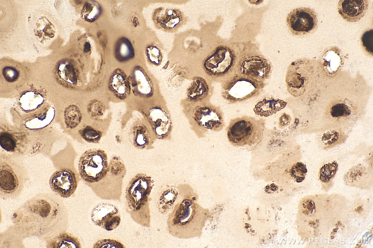 Immunohistochemistry (IHC) staining of human lung cancer tissue using Aggrecan Recombinant monoclonal antibody (84819-5-RR)